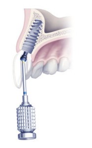 Korszerű fogimplantátum